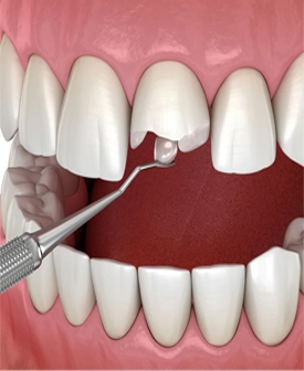 Estetik Restorasyonlar