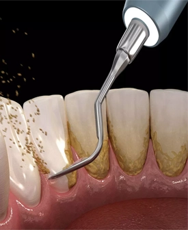 Diş Taşı Temizliği