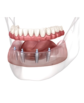 All on Four Tedavisi