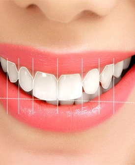 Gülüş Tasarımı (Hollywood Smile)