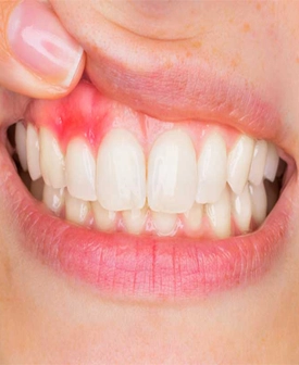 Diş Eti Tedavileri (Gummy Smile)