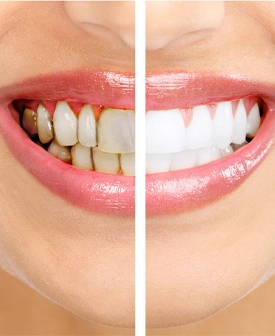 Diş Beyazlatma (Bleaching)