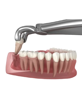 Gömülü Yirmi Yaş Diş Çekimi